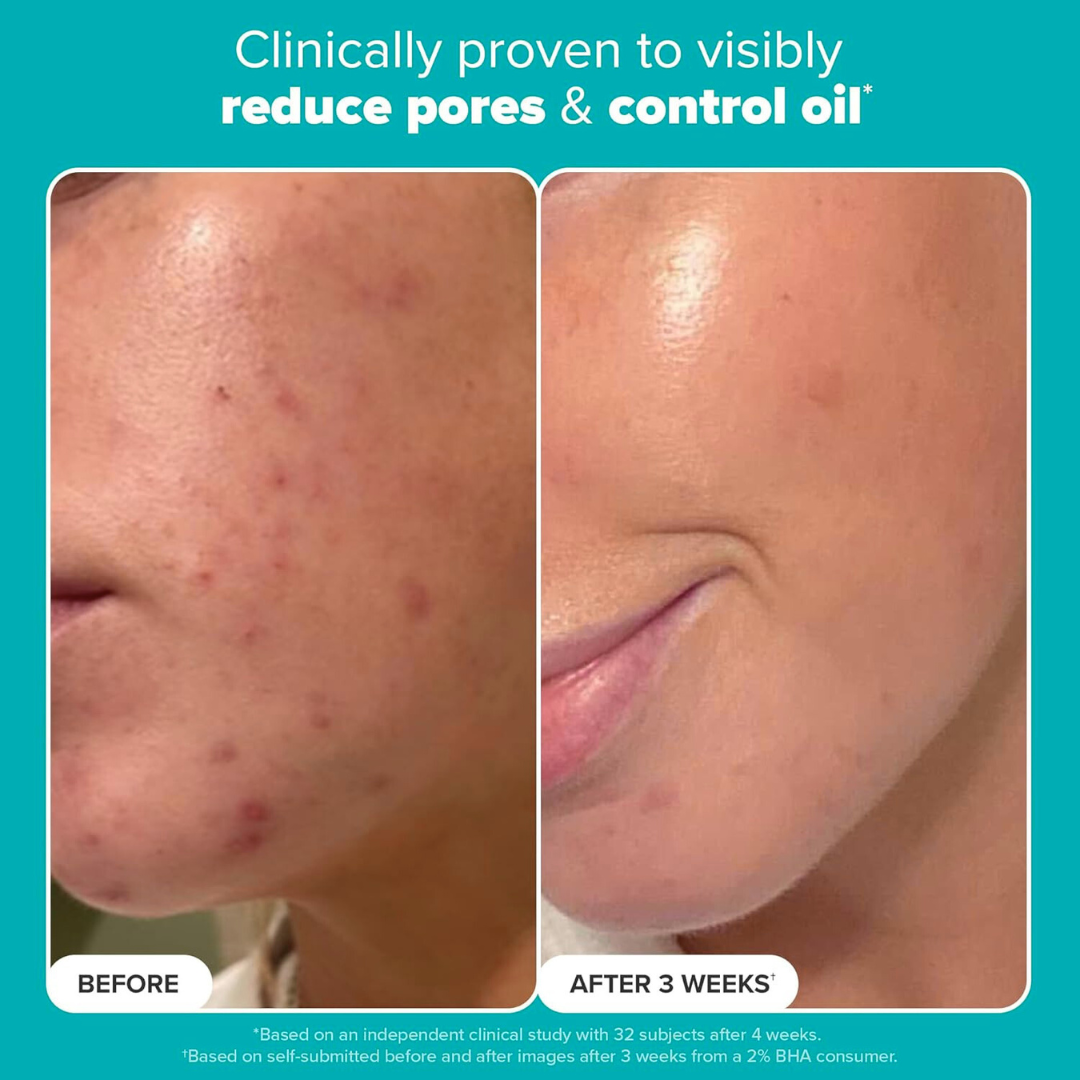Clearer Skin in 30 Days or Your Money Back!
